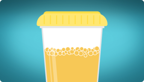 A graphic icon of a vial of foamy urine.